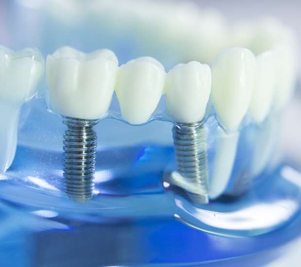Aberdeen Township Dental Implants